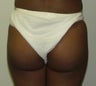 Butt Augmentation