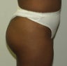 Butt Augmentation