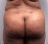Butt Augmentation