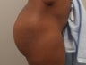 Butt Augmentation