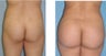 Buttock Augmentation