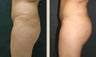 Buttock Augmentation