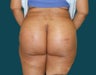 Buttock Augmentation