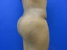 27 year old fat grafting to butt and hips - second view