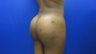 31 year old Brazilian Butt Lift - side view