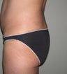 Butt implant augmentation