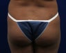 Butt Augmentation