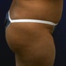 Butt Augmentation