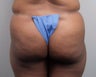Butt Augmentation