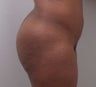 Butt Augmentation