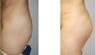 Buttock Augmentation
