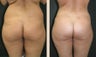 Buttock Augmentation