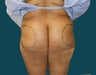 Buttock Augmentation