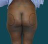 Buttock Augmentation