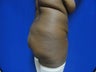 36 year old Brazilian Butt Lift - second view
