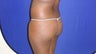 28 year old Brazilian Butt Lift - second view