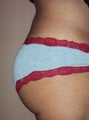 Butt implant augmentation