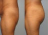 Buttock Implants with liposuction