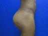 23 year old breast augmentation - side view