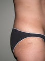 Butt implant augmentation