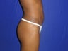 23 year old breast augmentation - side view