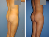 Buttocks Enhancement
