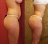 Butt Lift