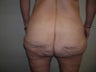 Gluteal Lift