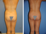 Buttocks Enhancement