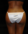 Buttocks Augmentation by Fat Grafting