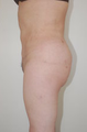Butt Augmentation
