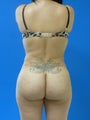 Brazilian Butt Lift