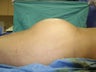 Butt Augmentation, Liposuction