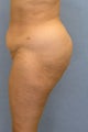 Fat grafting to Buttocks