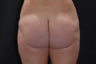 Buttock Augmentation through Fat Transfer