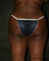 Buttock Augmentation