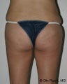 Buttock Augmentation