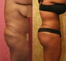 Brazilian buttock augmentation with fat grafting to the buttocks with liposuction in Los Angeles