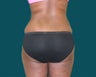 Buttocks augmentation with implants and fat grafting
