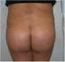 Buttocks augmentation with fat grafting and implants
