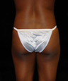 Buttocks Augmentation by Fat Grafting