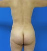 Brazilian Butt Lift