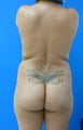 Brazilian Butt Lift
