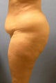 Fat grafting to Buttocks