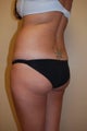 Brazilian Butt Lift