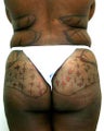 Liposuction and Buttock augmentation