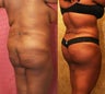 Brazilian buttock augmentation with fat grafting to the buttocks with liposuction in Los Angeles