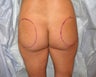Buttocks augumentation with implants