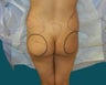 Buttocks augmentation with fat grafting and implants