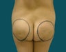 Buttocks augmentation with implants